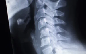 頸椎のレントゲン画像