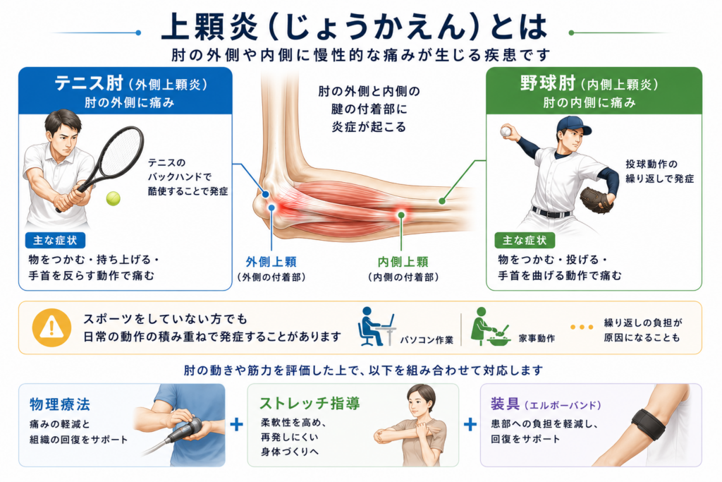 上顆炎の解説図。肘の外側が痛むテニス肘(外側上顆炎)と内側が痛む野球肘(内側上顆炎)の違いと対処法