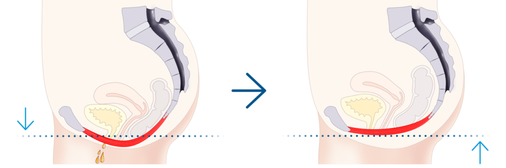 エムセラ（EMSELLA）とは？